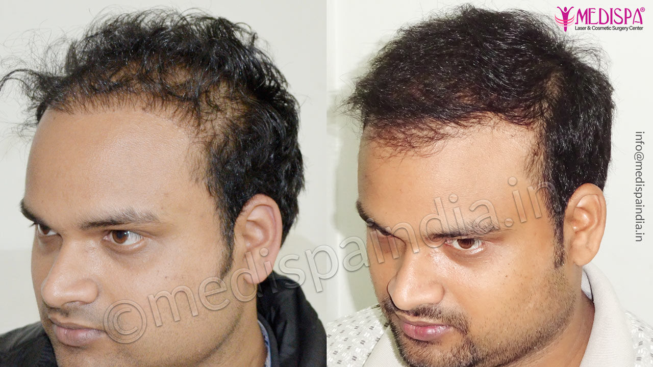 Hair Transplant before and after Result of a Repair case