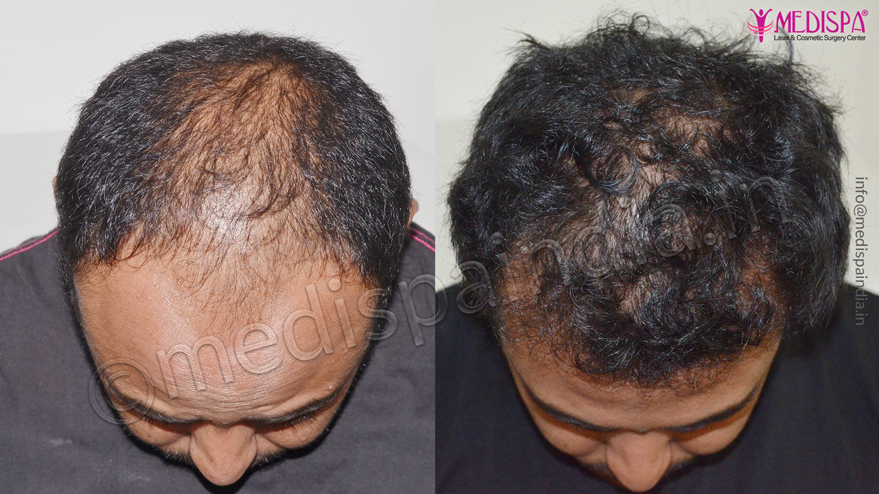 Best Hair Transplant Clinic in Roorkee Haridwar and Dehradun