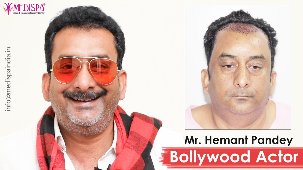 Bollywood male actors Hair Transplant and Plastic surgery   rBollyBlindsNGossip