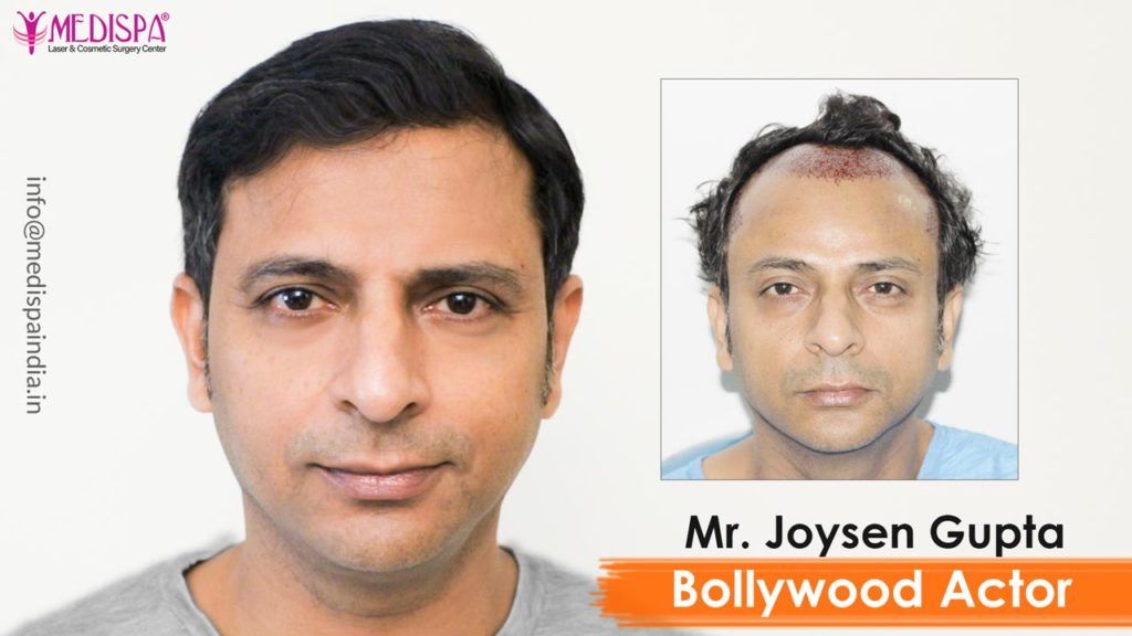 10 Bollywood Celebrities Who Got A Career Boost After Getting A Hair  TransplantPatch  DotComStories