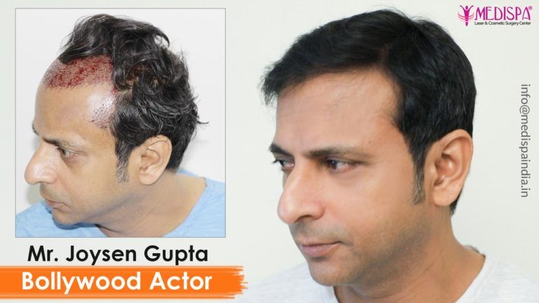 Bollywood Actor – Joysen Gupta Hair Transplant Results