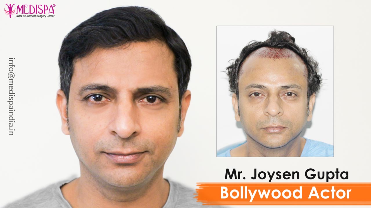 Bollywood Actor – Joysen Gupta Hair Transplant Results