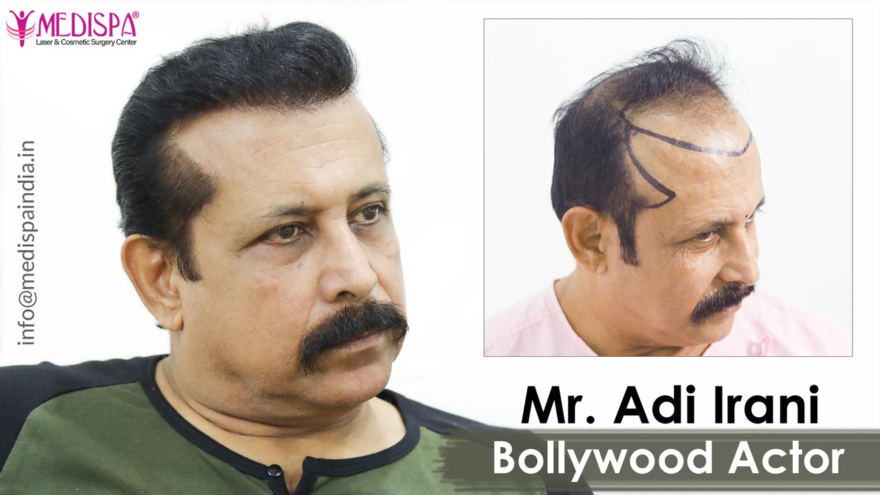 Bollywood Actor, Adi Irani Hair Transplant Results - Medispa