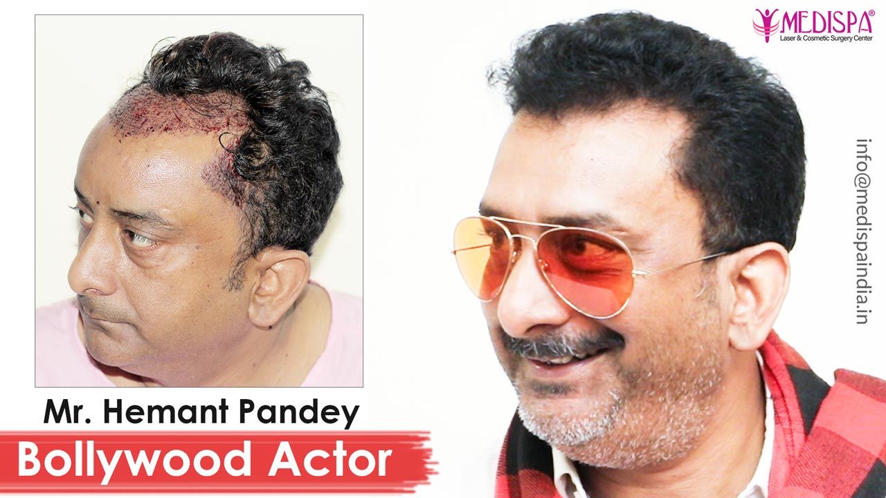 Bollywood Actor  Hemant Pandey Hair Transplant Results