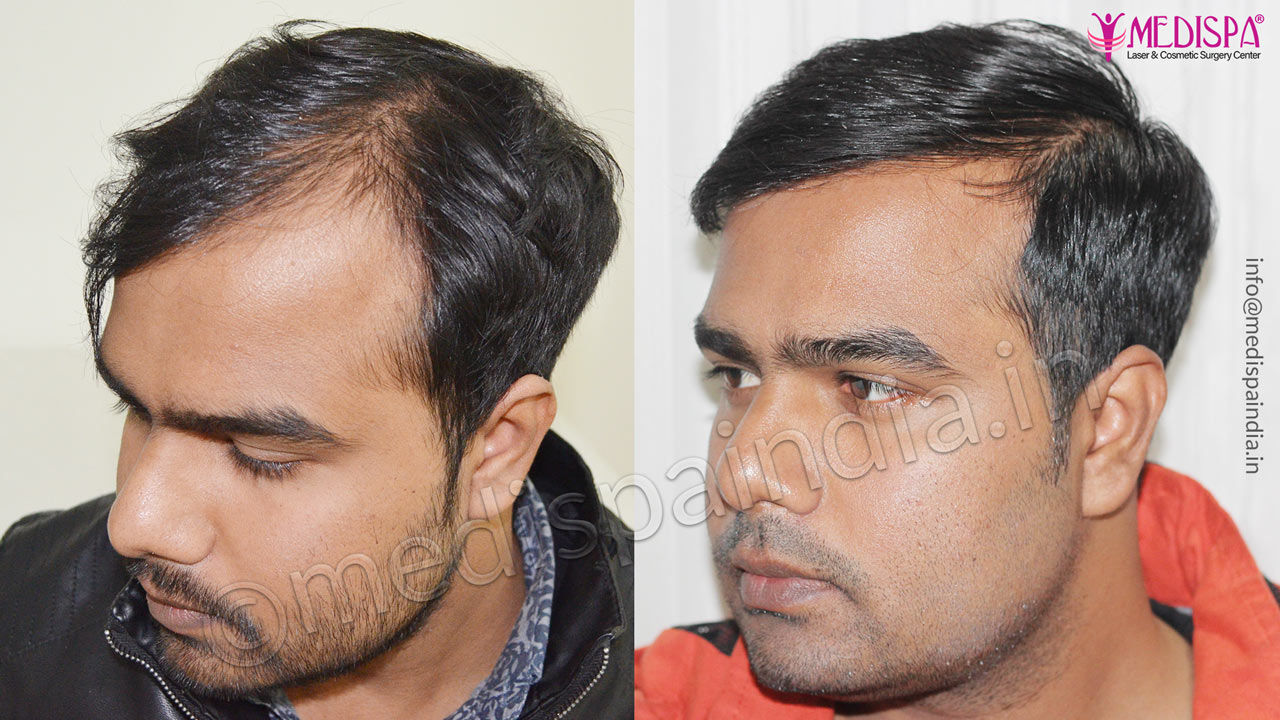 Hair Bonding in Chennai  NonSurgical Hair Replacement