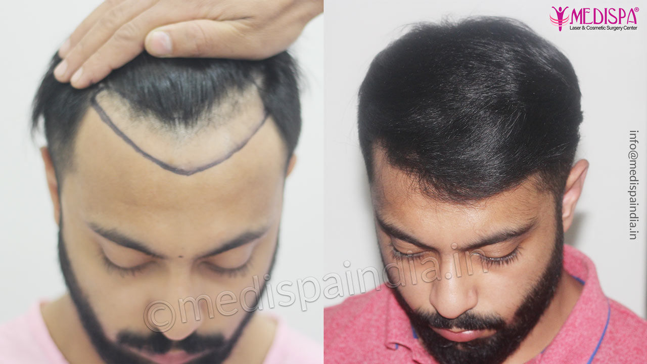 Pain free hair transplant treatment in Mumbai  Pay with nocost EMI   Gmoneyin