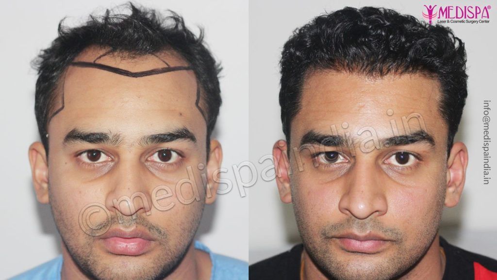 10 Best Hair Transplant Surgeons in Thiruvananthapuram  Near Me 2023   ClinicSpots