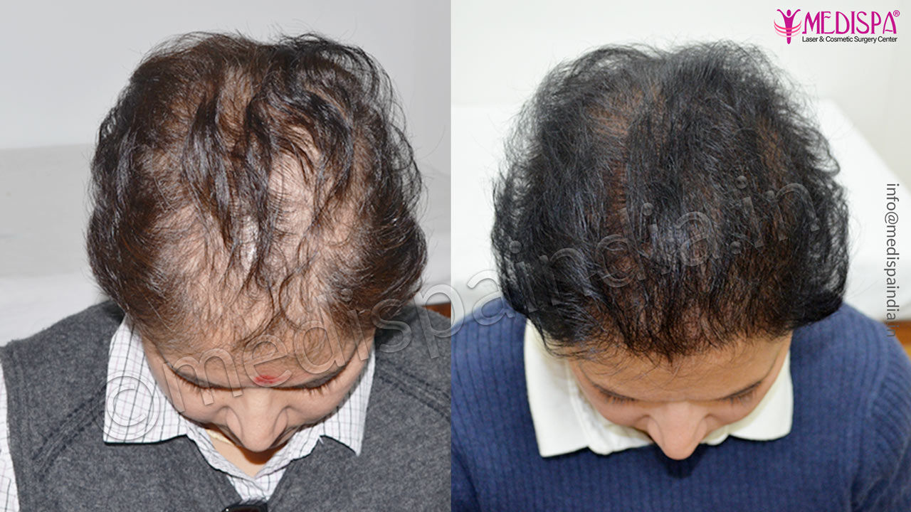 Female Hair Transplant Photo Gallery Female Hair Transplant Results