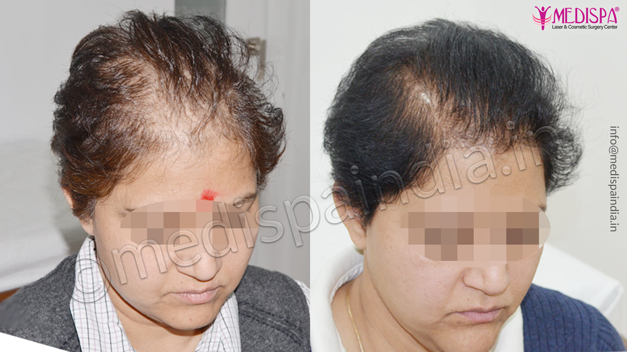 Female Hair Restoration Results After 12 Months at Medispa