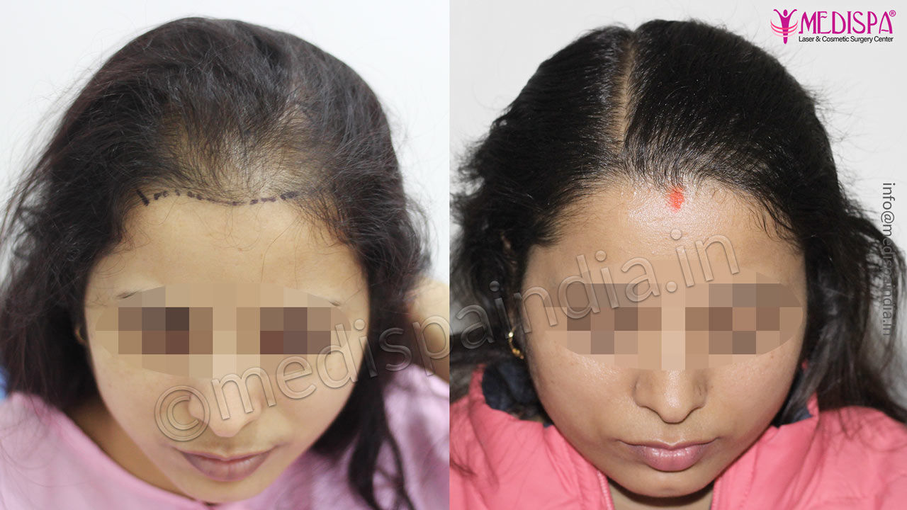 FUE Technique Hair Transplant for Women  Medco Healthco  Stay Safe and  Healthy