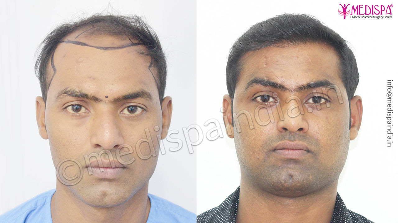 Hair Transplant in Lucknow Best Cost Surgeon  Procedure