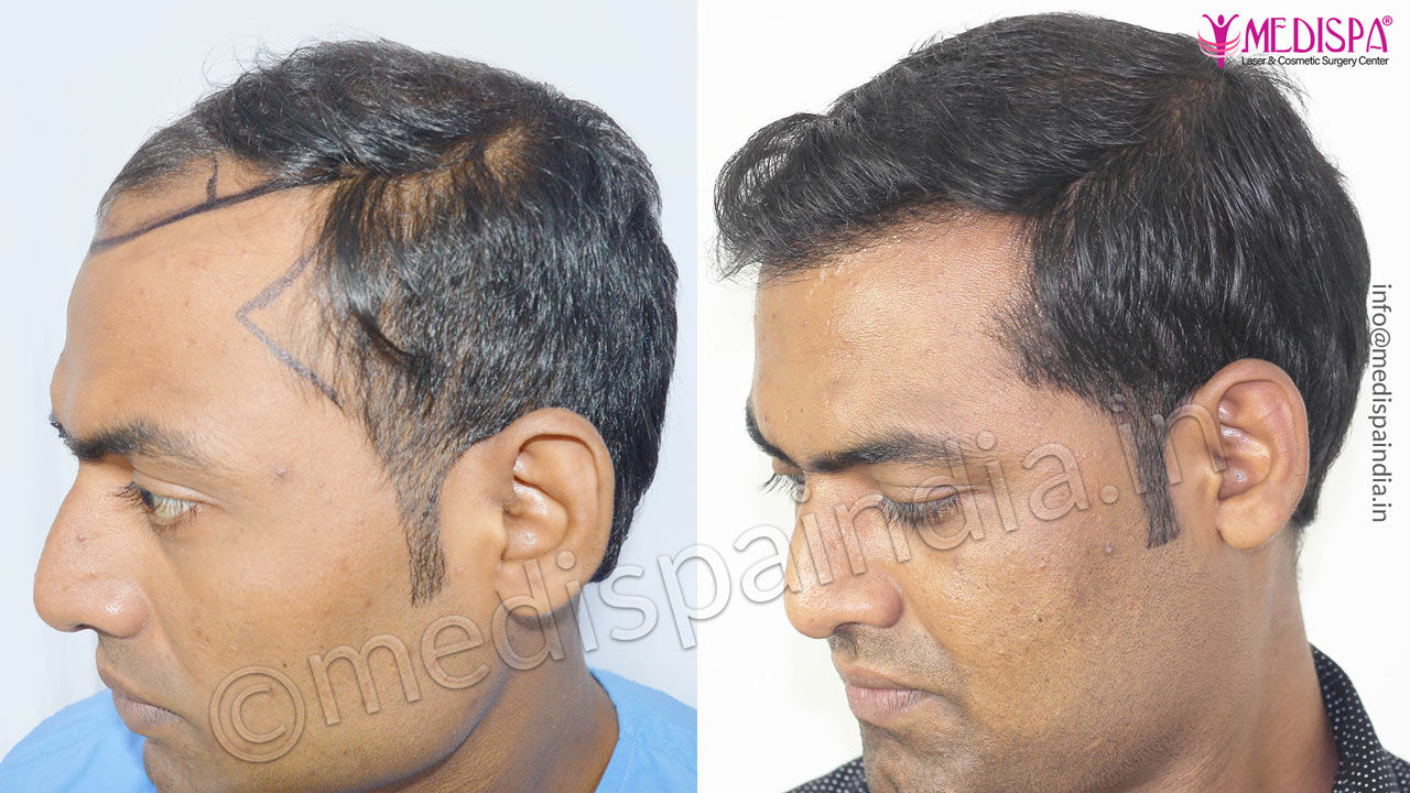 Sushil Chhaparwal Age 28 Grade III FUT Hair Transplant Results | Top Hair Transplant Center Delhi, Jaipur | Hair Transplant Cost India Sushil Chhaparwal Age 28 Grade III FUT Hair Transplant Results | Top Hair Transplant Center Delhi, Jaipur | Hair Transplant Cost India