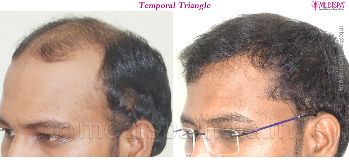 Before and After Hair Transplant Results in Bangalore, India
