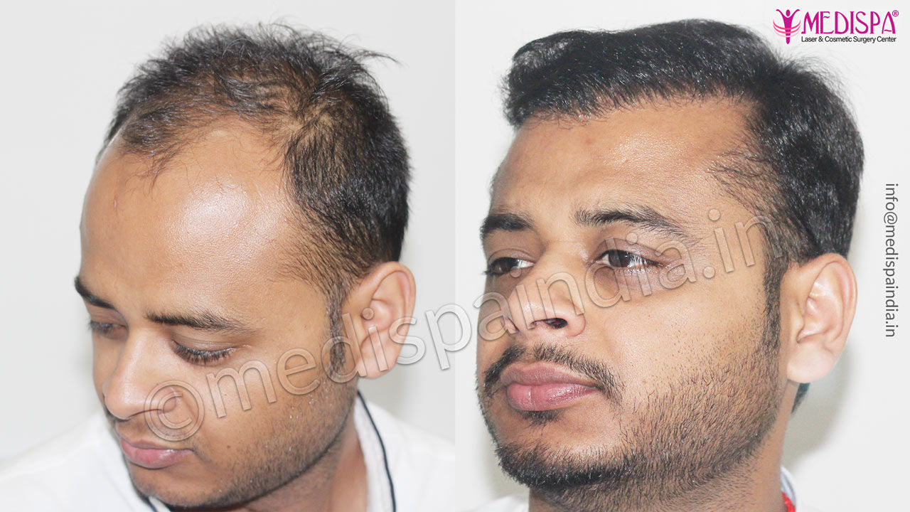 Hair Transplant Testimonials | Reviews, Videos | Medispa Hair Transplant Testimonials | Reviews, Videos | Medispa