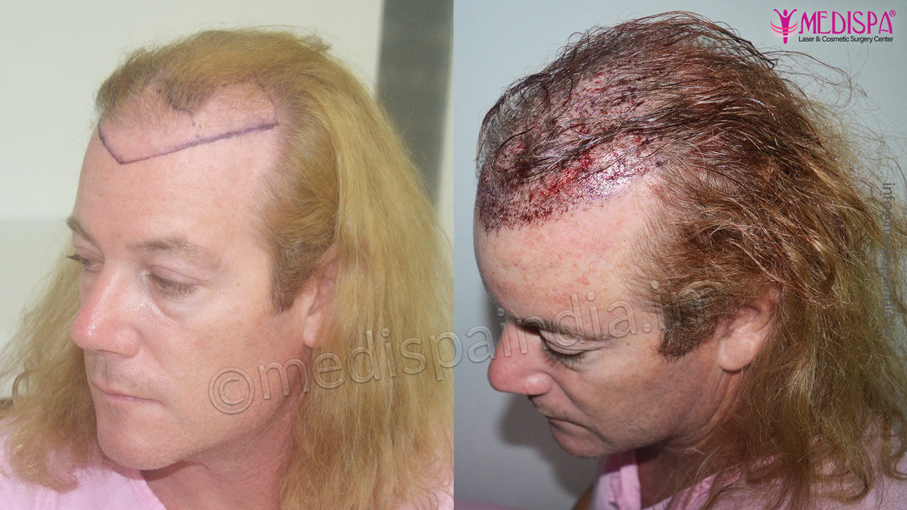 Male Hair Transplant Before After Result in Perth, Australia