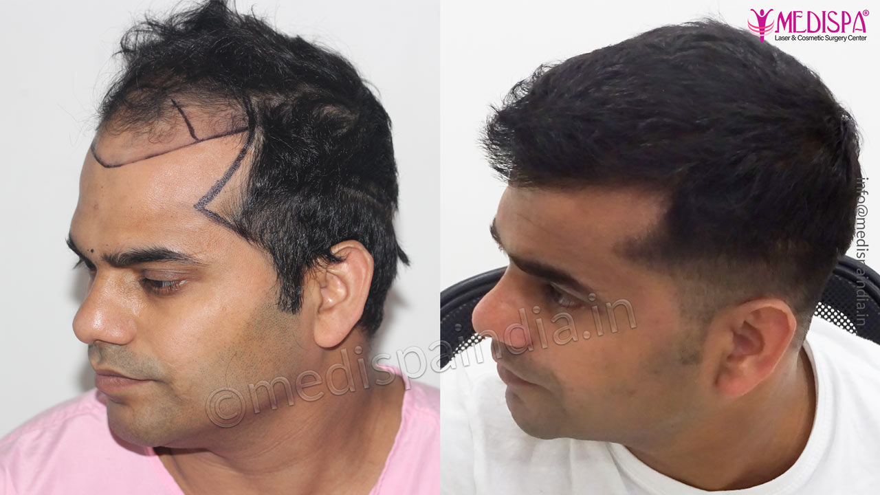 Hair Transplant Results of Melbourne, Australia Patient