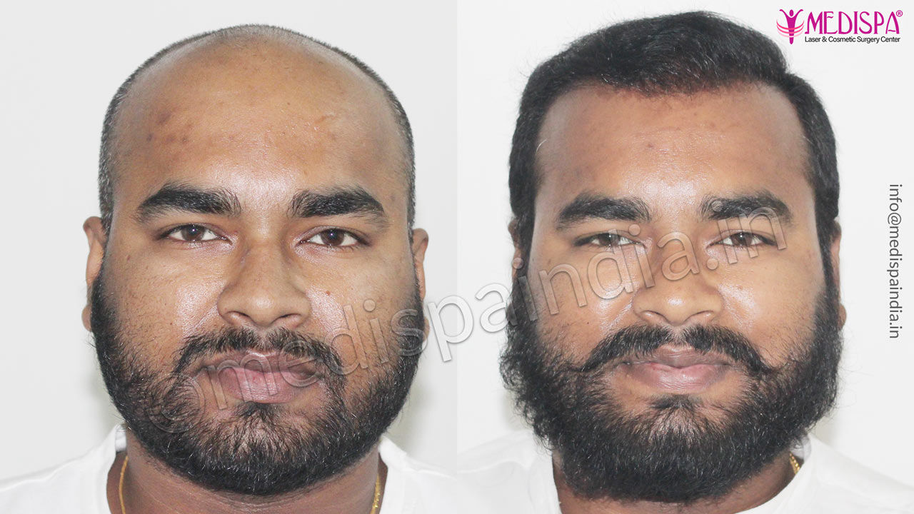 Hair Transplant Results in Bangalore Hair Transplant India