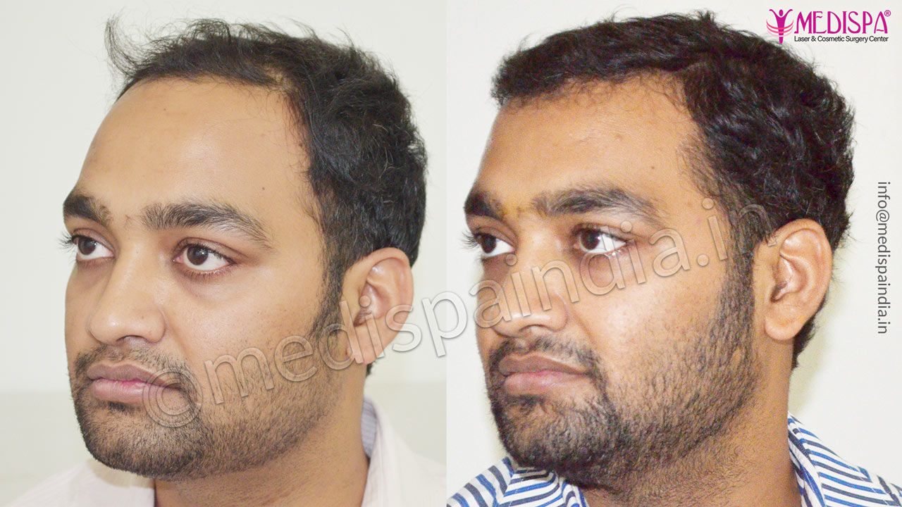 Before and After Hair Restoration Photos Medispa India