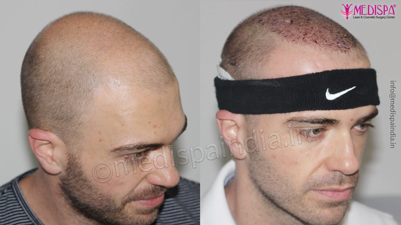 Best Hair Transplant Before After Results in Melbourne