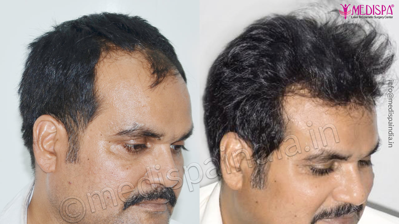 Hair Loss Treatment Results by Hair Transplant Medispa