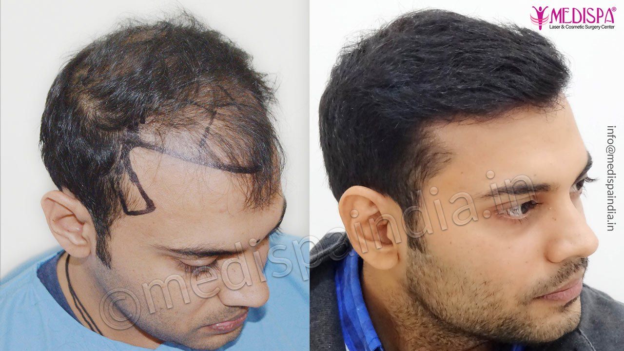 Hair Transplant Results Gallery  Before and After Images  Reviva Clinic