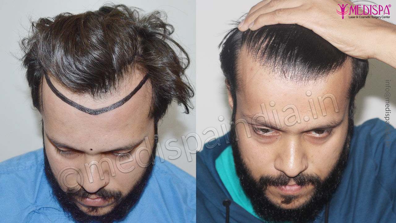 Recover Hair Transplant  Natural Hairline  Painless Procedure