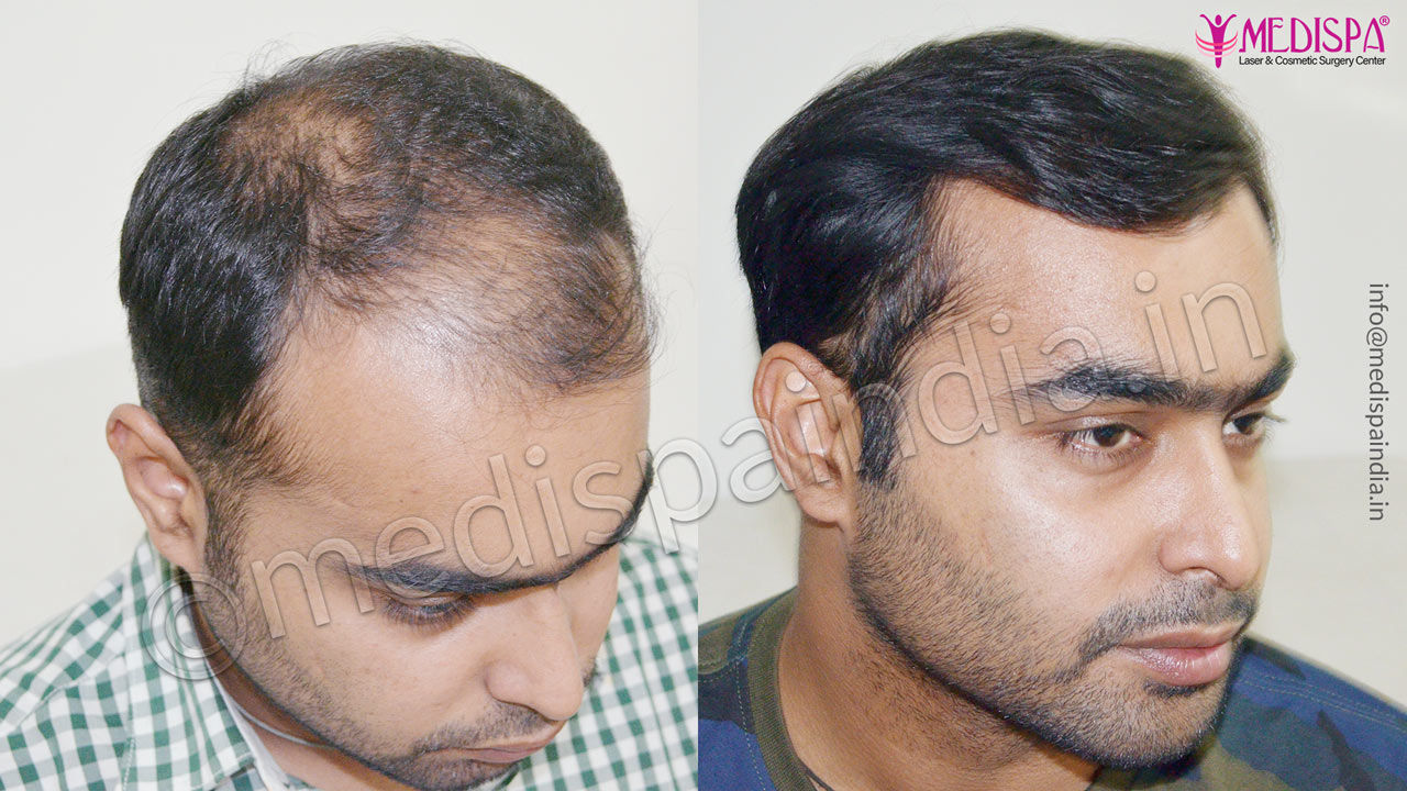 Hair Transplant Results in Indore | Natural Hairline Implant Hair Transplant Results in Indore | Natural Hairline Implant