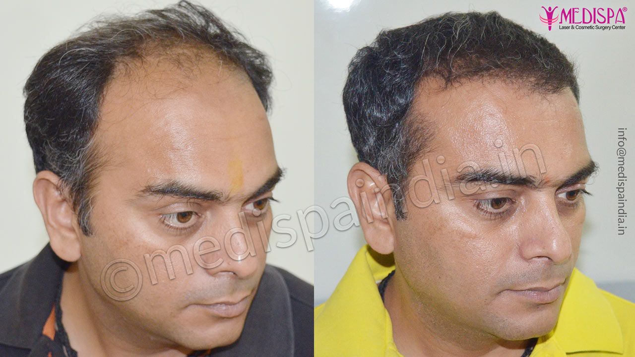 Photo Gallery  Hair Restoration Results in Surat  Medispa