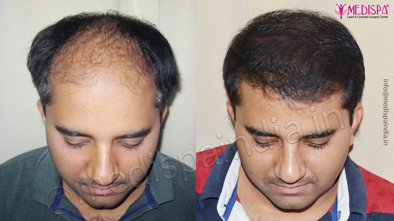Corrective Hair Transplant, Before and After Photos, Medispa