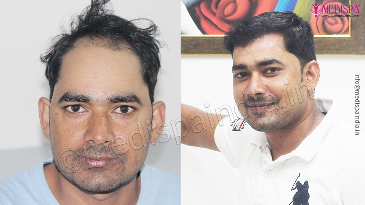 Before After Hair Transplant Results of 12 Months in Lucknow