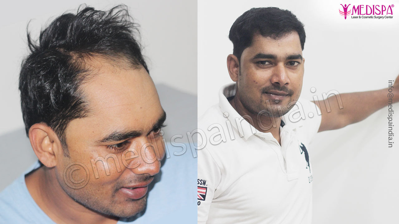 Before After Hair Transplant Results of 12 Months in Lucknow Before After Hair Transplant Results of 12 Months in Lucknow