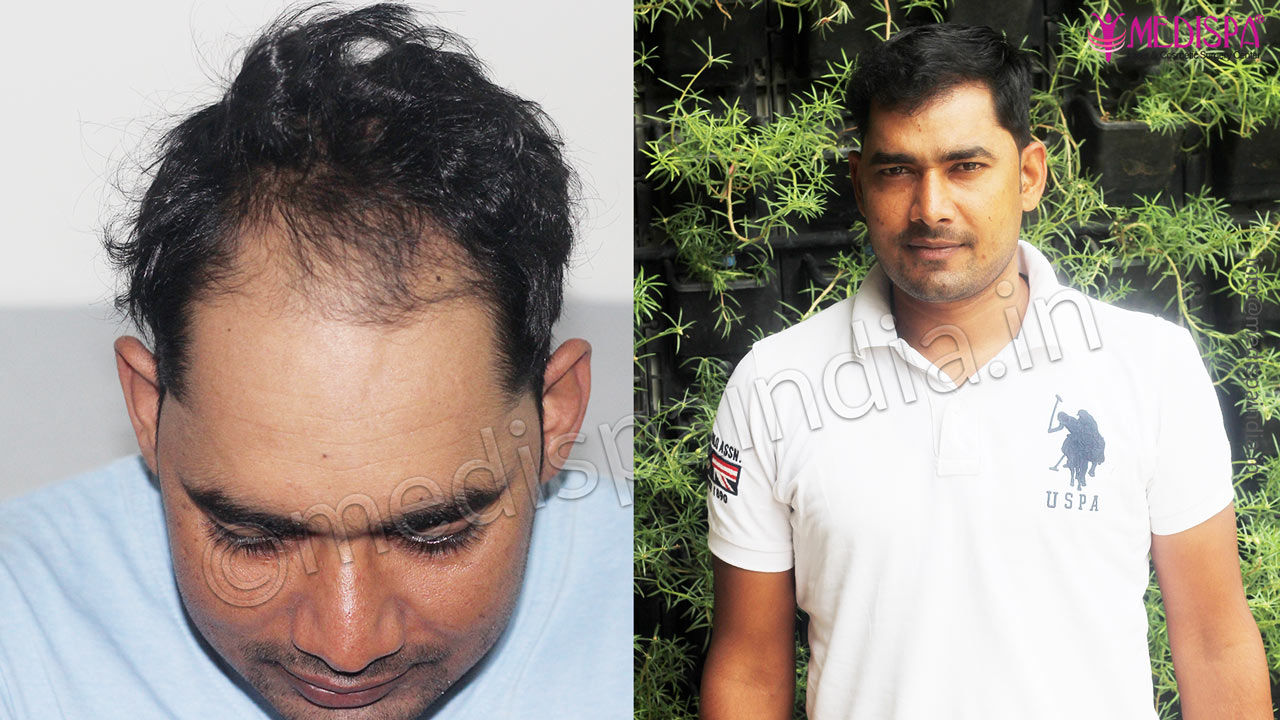 Before After Hair Transplant Results of 12 Months in Lucknow Before After Hair Transplant Results of 12 Months in Lucknow