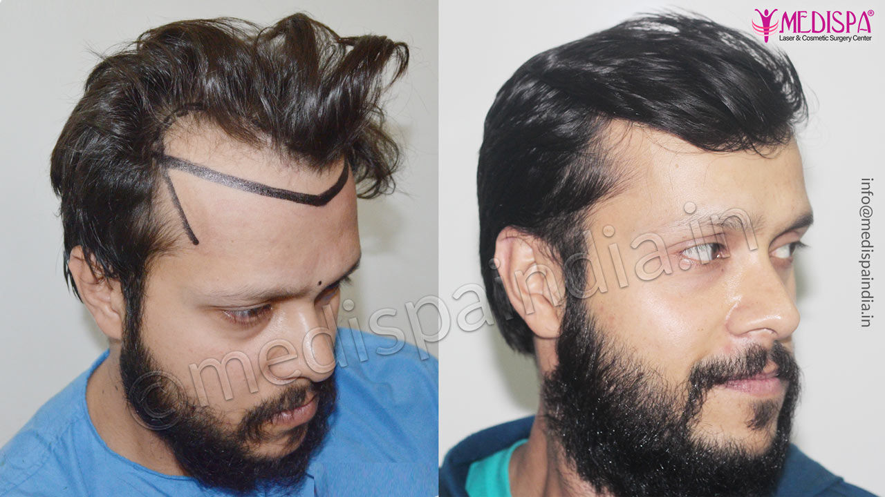 Hair Transplant Results After 11 Months, Natural Hairline Hair Transplant Results After 11 Months, Natural Hairline