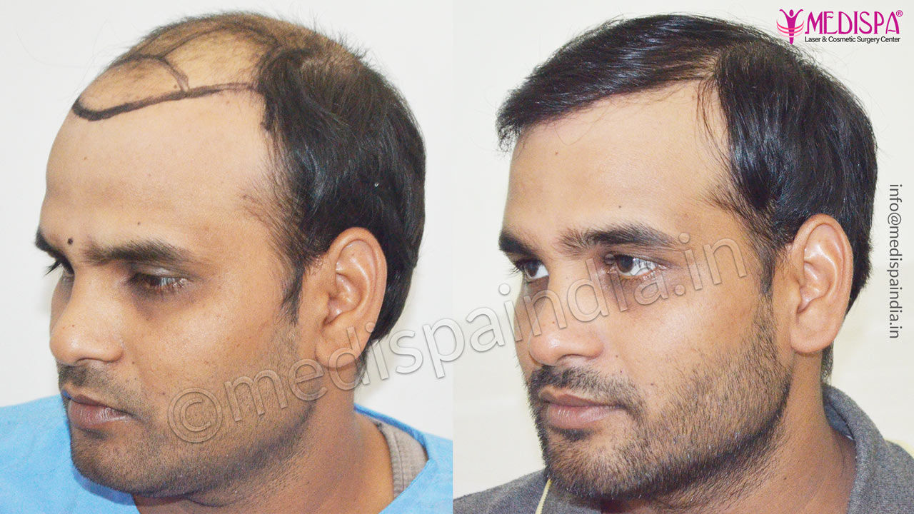 Best Hair Transplant Clinic in Ahmedabad Top Hair Transplant in Ahmedabad