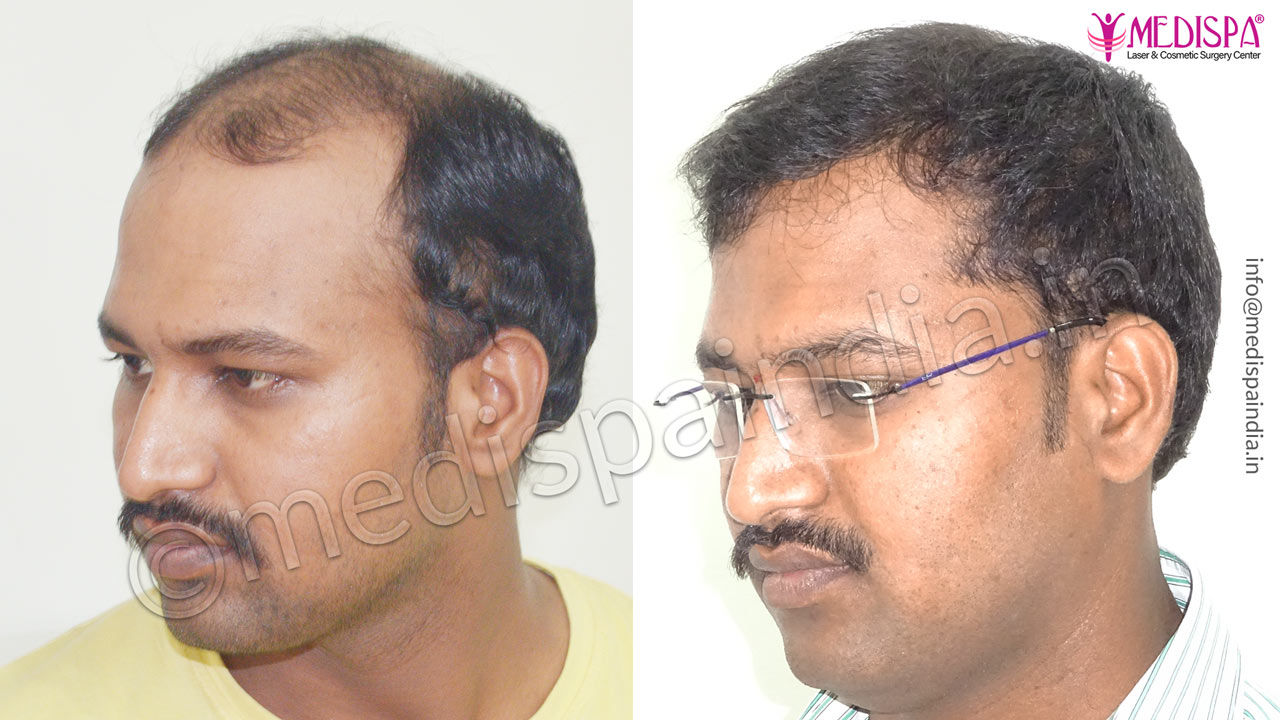 Before and After Hair Transplant Results in Bangalore, India