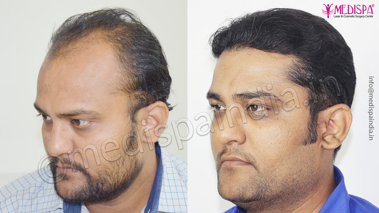 Best Hair Transplant Results in Mumbai at Medispa India Best Hair Transplant Results in Mumbai at Medispa India