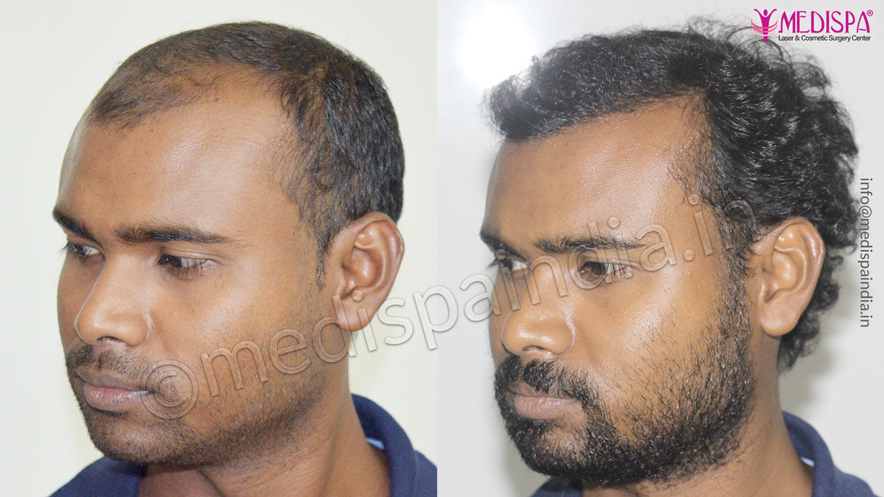 Best Hair Transplant In Bangalore Best Cosmetic Surgeon in Bangalore  Liposuction Metal Print by CurlsnCurves  Fine Art America