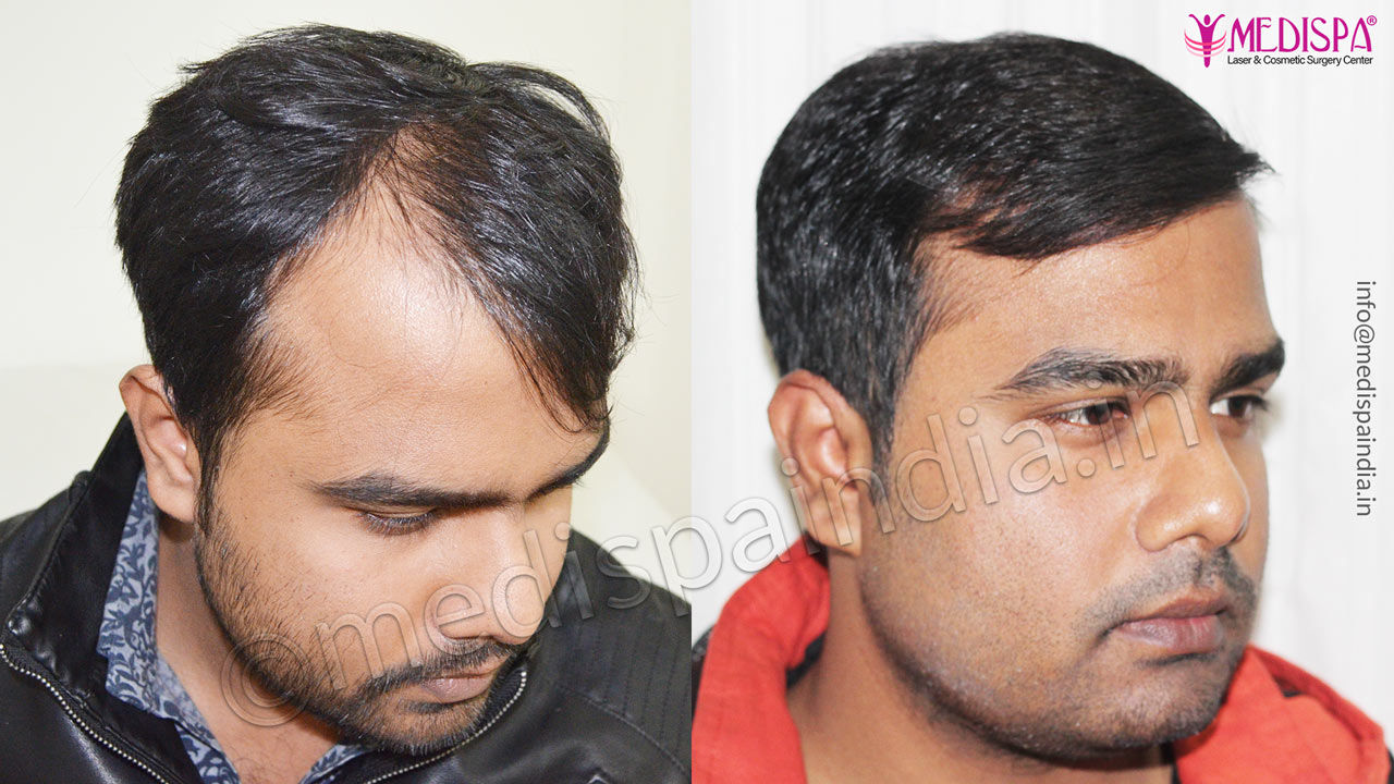 best hair transplant clinic  Exclusive Plastic Surgery Clinic for Men in  Chennai