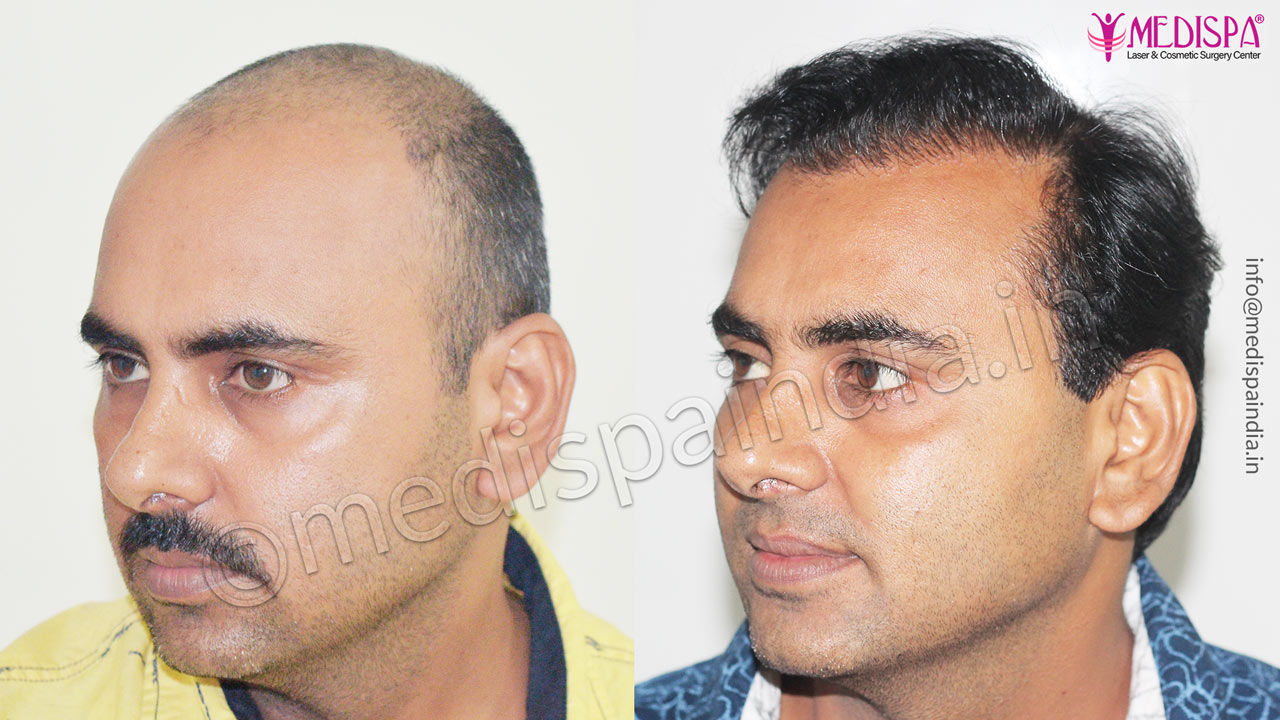 Who Can Opt for the Best Hair Transplant in Faridabad