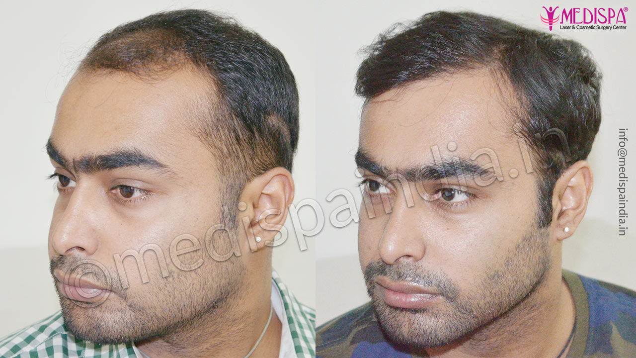 Hair Transplant Results in Indore | Natural Hairline Implant Hair Transplant Results in Indore | Natural Hairline Implant