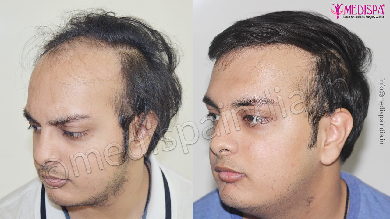 Hair transplant Jodhpur, Rajasthan Hair transplant Jodhpur, Rajasthan