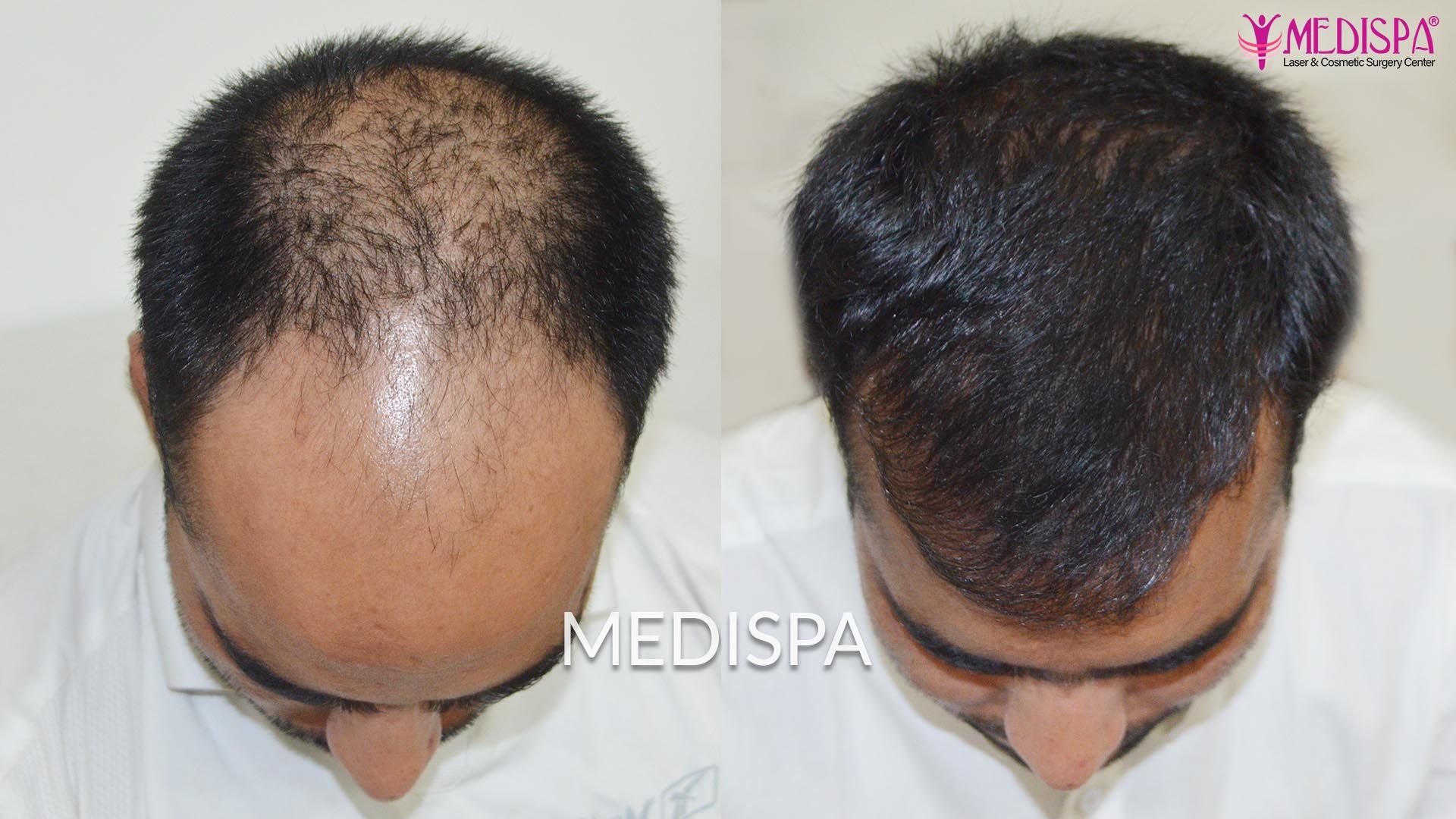 Celeb Hair Transplant in India  ACTOR MIHIR Mishra Surgery  MEDISPA India   Dr Suneet Soni India  YouTube