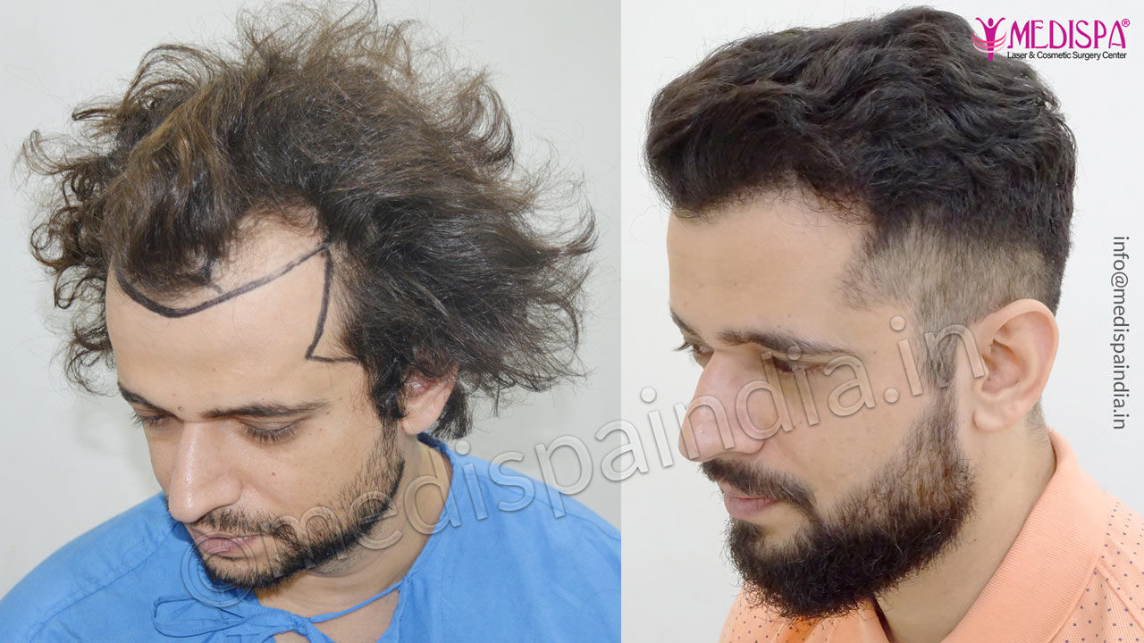 How To Get The Best Hair Transplant Surgery in Ghaziabad