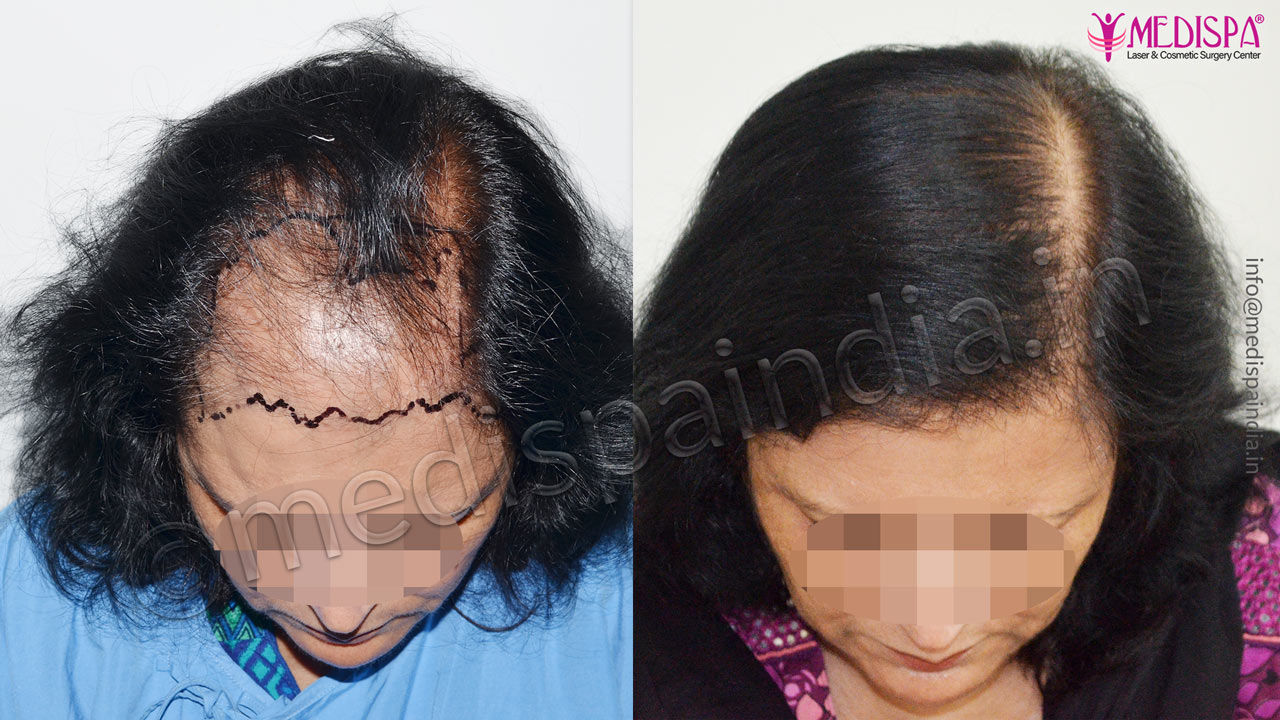 Best Female Hair Transplant Results - Before After Photos