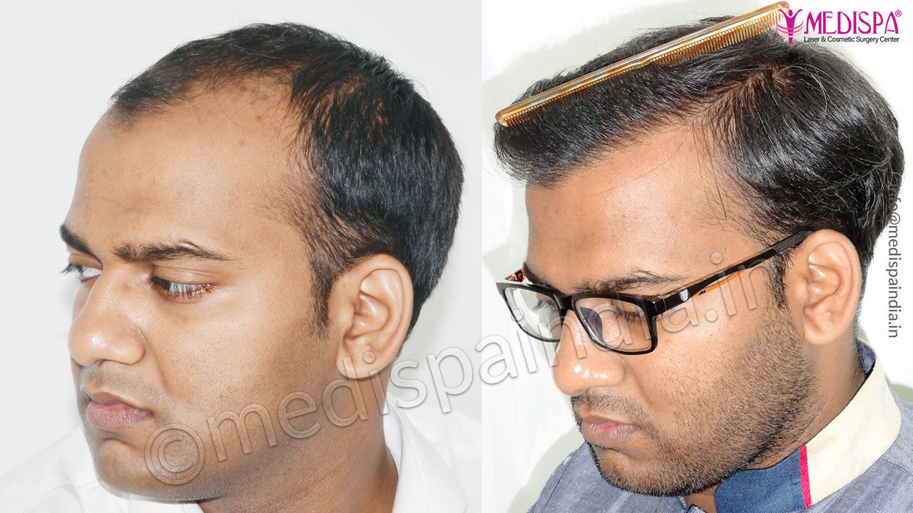 Best FUT Hair Transplant Before After Results Jaipur India