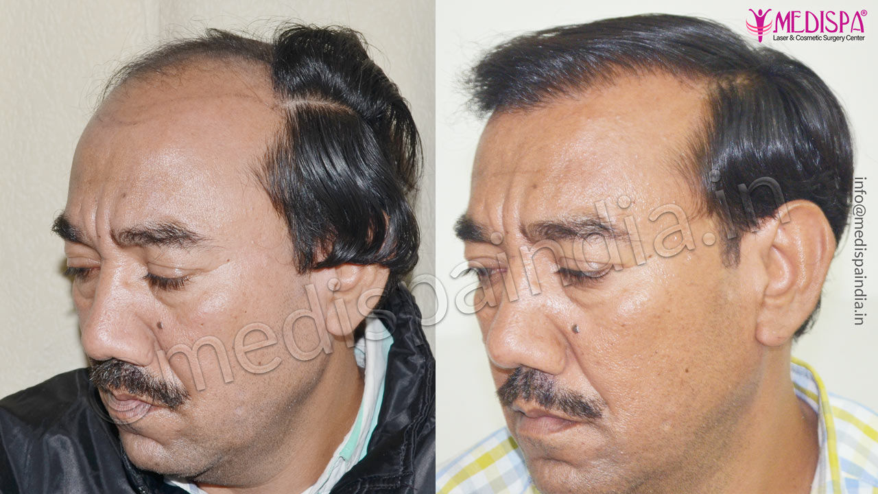 Hair Transplant Results in Jaipur, Rajasthan - Medispa India Hair Transplant Results in Jaipur, Rajasthan - Medispa India