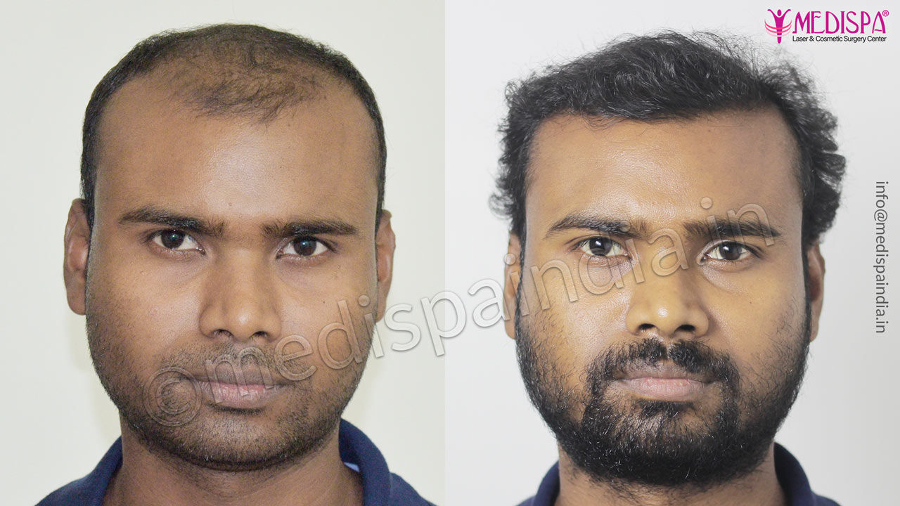 Bangalore Hair Transplant Before After Medispa India