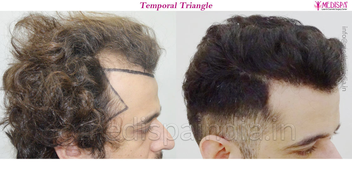 Hair Transplant Before and After Gallery Dr Suneet Soni