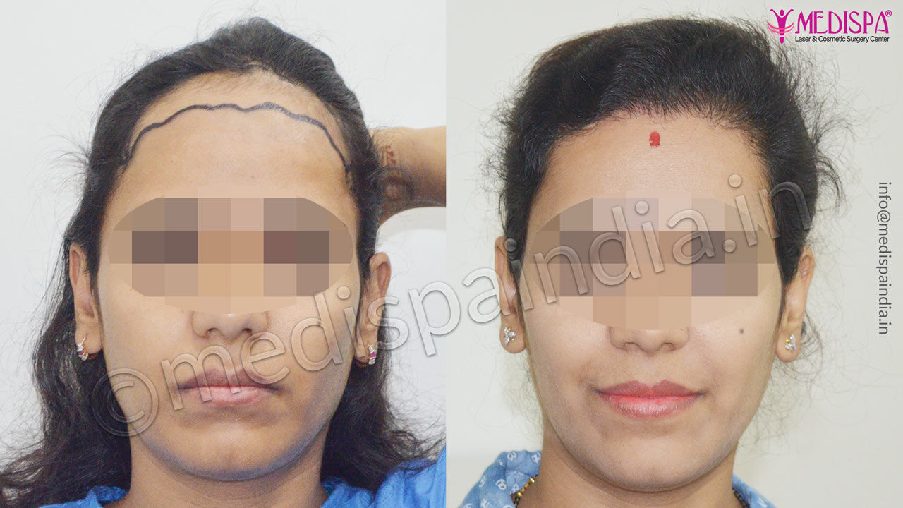 Women's Hair Transplant Before and After Gallery Medispa