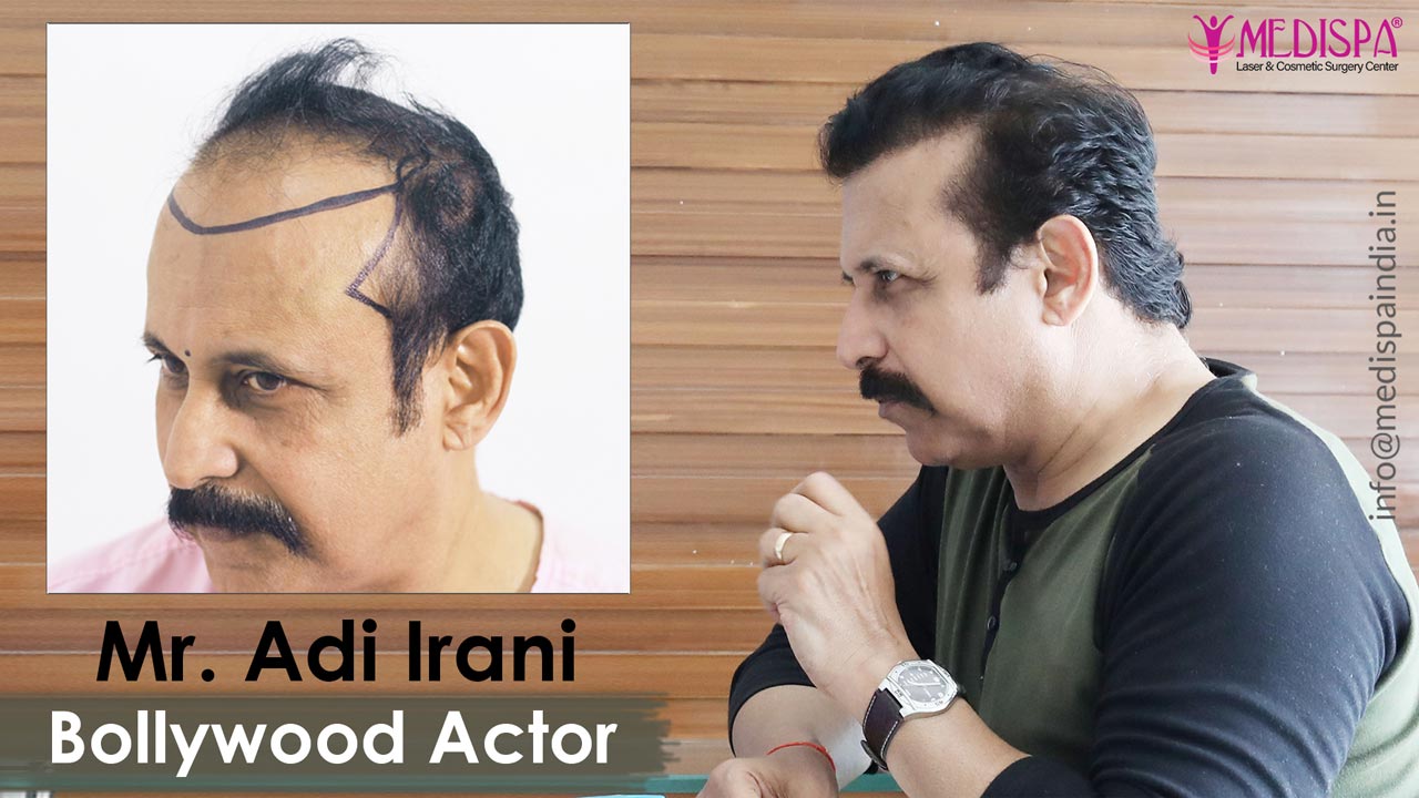 Bollywood Actor, Adi Irani Hair Transplant Results - Medispa Bollywood Actor, Adi Irani Hair Transplant Results - Medispa